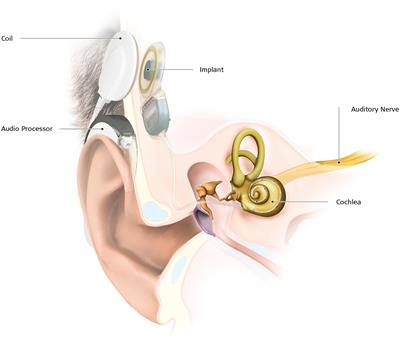 Brain Morphological Modifications in Congenital and Acquired Auditory Deprivation: A Systematic Review and Coordinate-Based Meta-Analysis